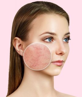 L'hiver, la saison idéale pour le laser vasculaire