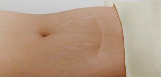 Tout savoir sur les vergetures : comprendre et traiter