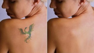 Le détatouage : Un pas parfois difficile à faire