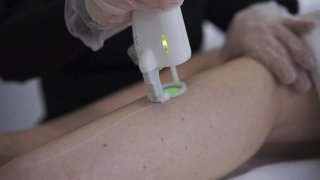 Épilation laser et soleil : Quelles précautions prendre ?