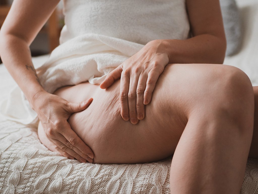 Traitements Esthétiques Cellulite et Graisse à Metz